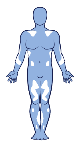 Non-segmental vitiligo